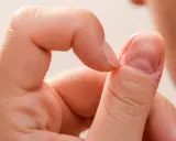 Zbliżenie na palec z widocznymi, wypukłymi paznokciami i suchą skórą wokół.