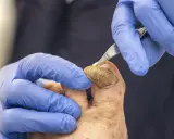 Podolog delikatnie usuwa zrogowaciałe, przypominające krogulcze paznokcie, używając specjalistycznego narzędzia.
