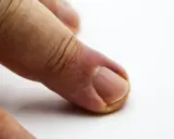 Widoczna dziura w paznokciu przy skórce, zaczerwienienie wokół wału paznokciowego.