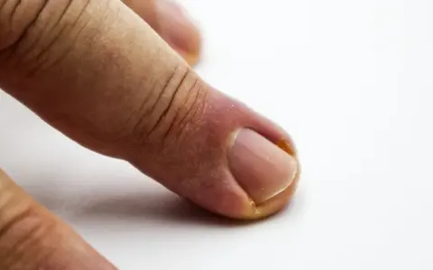 Widoczna dziura w paznokciu przy skórce, zaczerwienienie wokół wału paznokciowego.
