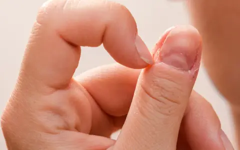 Dłoń z widocznymi, mocno obgryzione paznokcie i skórki wokół nich.