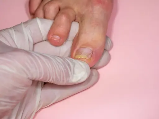 Dłoń w białej rękawiczce bada paznokieć palca stopy z widocznym zażółceniem i oddzieleniem od płytki.