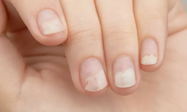 Dziecko ma kruche paznokcie z białymi plamkami, które wyglądają na osłabione i łamliwe.